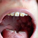 Assessments used when nausea comes with no vomiting