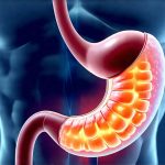 Can Acid Reflux Be Caused by a Lack of Stomach Acid?