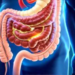 Can Gut Hypersensitivity Lead to False Bloating Sensations?