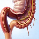 Can Intestinal Adhesions Lead to Persistent Bloating?
