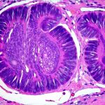 Digestive diagnostics used in autoimmune flares