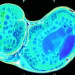 Digestive scans that detect early gallbladder trouble