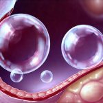 GERD and a Feeling of a Bubble in the Esophagus