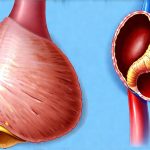 GERD and Sudden Spasms in the Diaphragm Area