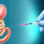 GERD and the Role of Stomach Acid Testing
