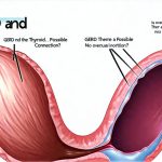 GERD and the Thyroid: Is There a Possible Connection?