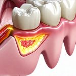 How Acid Reflux Can Cause Dental Sensitivity