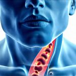 How Acid Reflux Can Lead to Hoarseness and Sore Throat