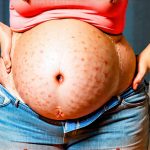 How Bariatric Surgery Affects Bloating and Gas