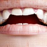 How GERD Affects Morning Breath and Oral Health