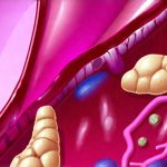 How Long Does It Take to Heal From Chronic GERD?
