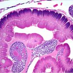 Stool Instability From Poor Gut Flora Diversity
