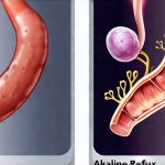 The Difference Between Acidic and Alkaline Reflux Symptoms