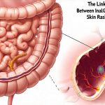 The Link Between Intestinal Gas and Skin Rashes