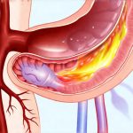 The Relationship Between Acid Reflux and Bloating