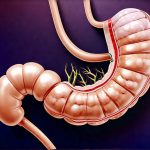 The Role of Gut Permeability in Chronic Gas Issues