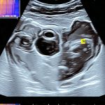 Ultrasound as the first step in investigating abdominal symptoms