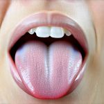 What a White Tongue Might Reveal About Your Reflux