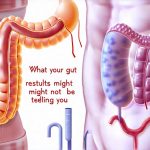 What your gut test results might not be telling you