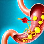 What your stomach is trying to tell you through reflux
