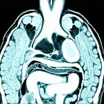 When an MRI is better than a CT for gut issues