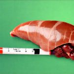 When to worry about blood tests showing liver issues