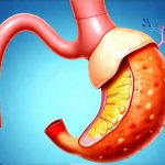 Why GERD Symptoms Are Often Worse on an Empty Stomach