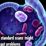 Why standard scans might miss early gut problems
