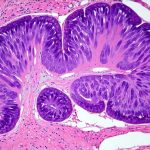 How Constant Low-Level Inflammation Affects Gut Mucosa And Leads To Indigestion